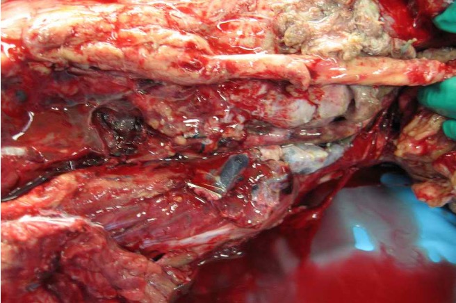 Popliteal artery graft 1